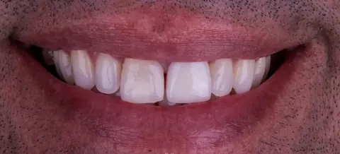 Antes: lentes de contato dental
