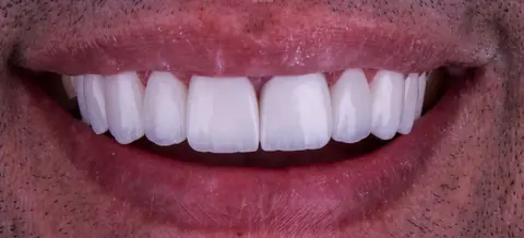 Depois: lentes de contato dental