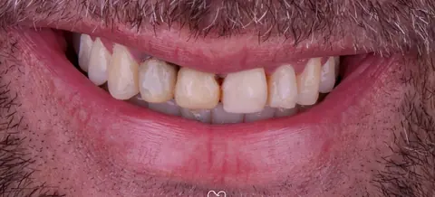 Antes: lentes de contato dental