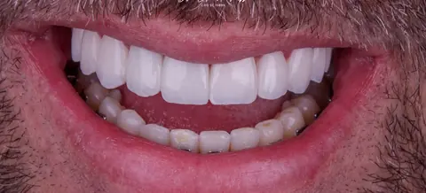 Depois: lentes de contato dental