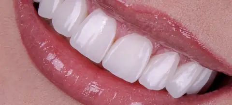 Sorriso com lentes em resina, em close