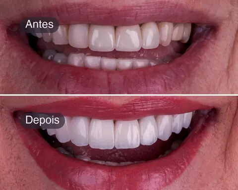 Antes e depois de 10 lentes em resina feitas em uma consulta, caso real