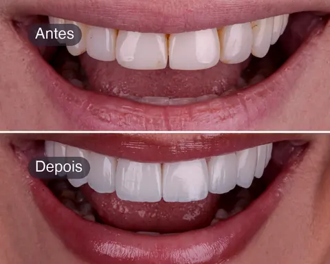 Antes e depois da troca de lentes em resina antigas, caso real