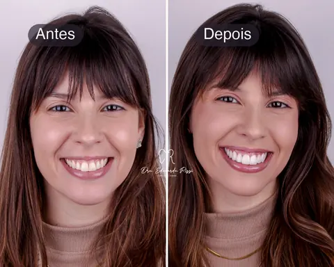 Antes e depois de um sorriso planejado com lentes, caso real